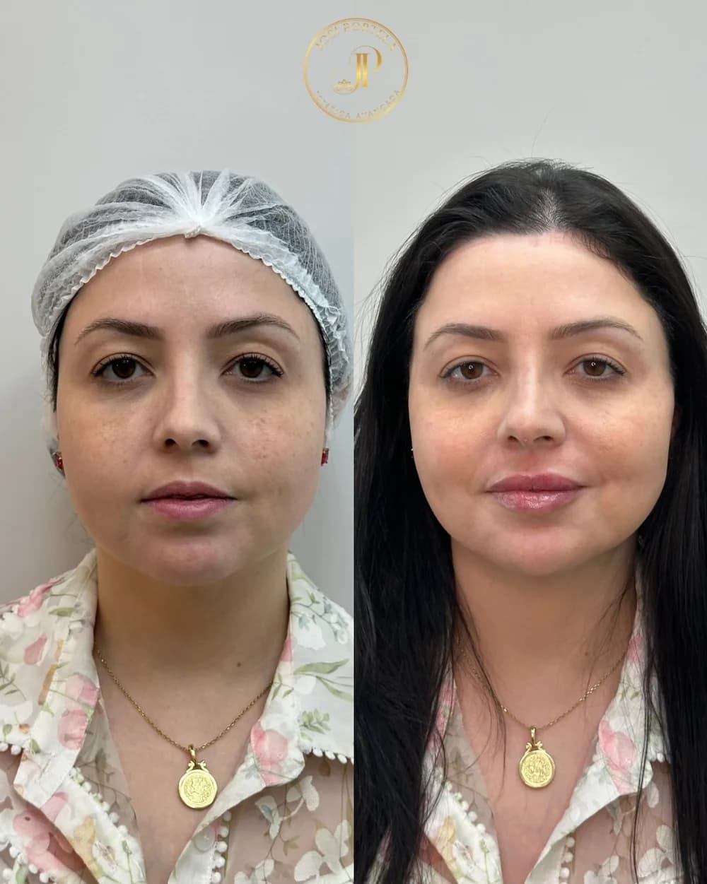 Resultado de tratamento facial realizado pela Dra. Josi — caso 2