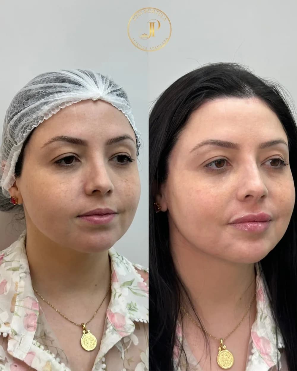 Harmonização facial — comparativo 1