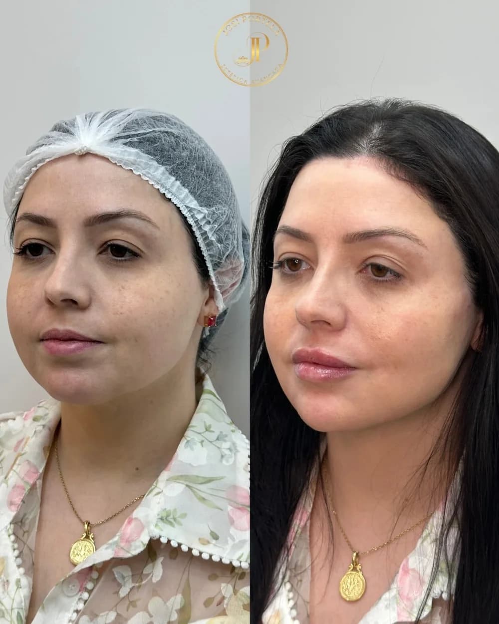 Harmonização facial — comparativo 2