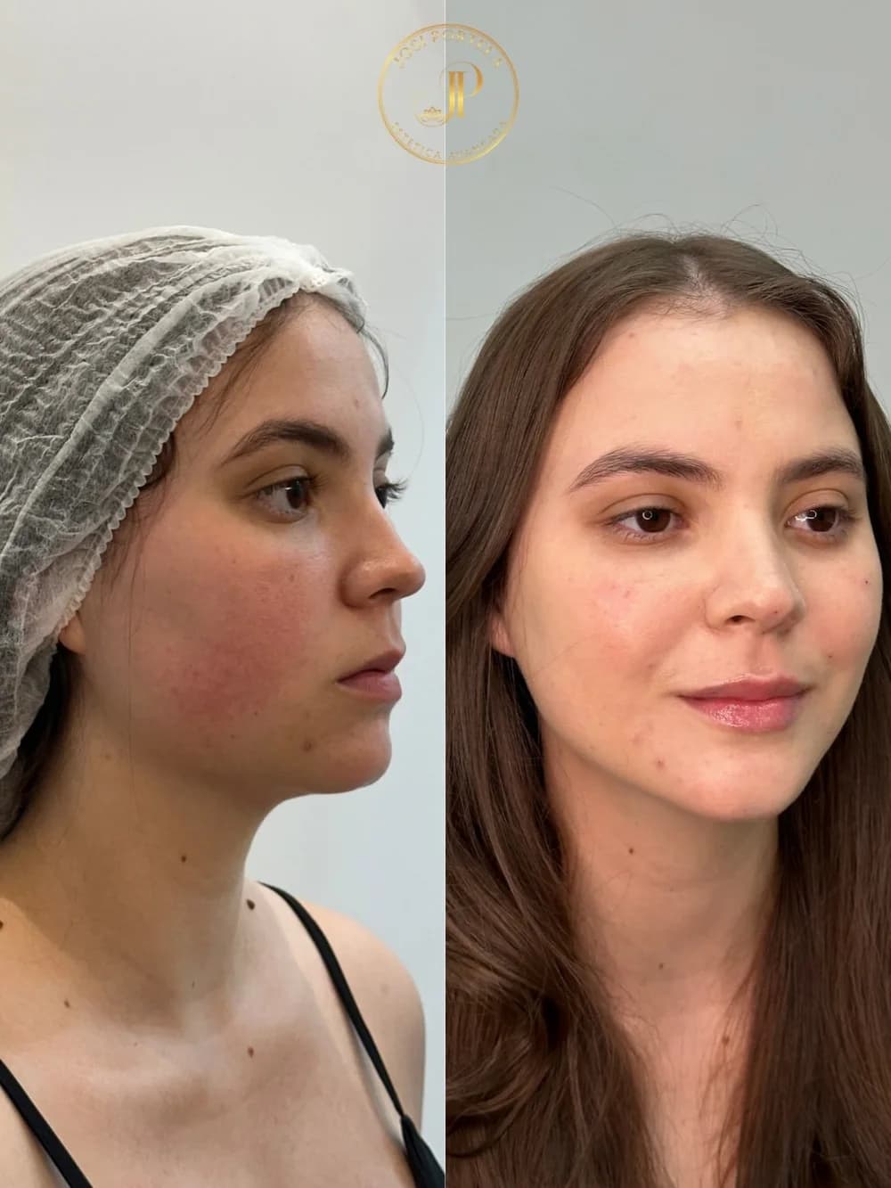 Preenchimento facial — comparativo 1