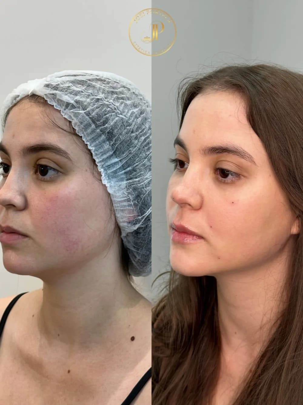 Preenchimento facial — comparativo 2