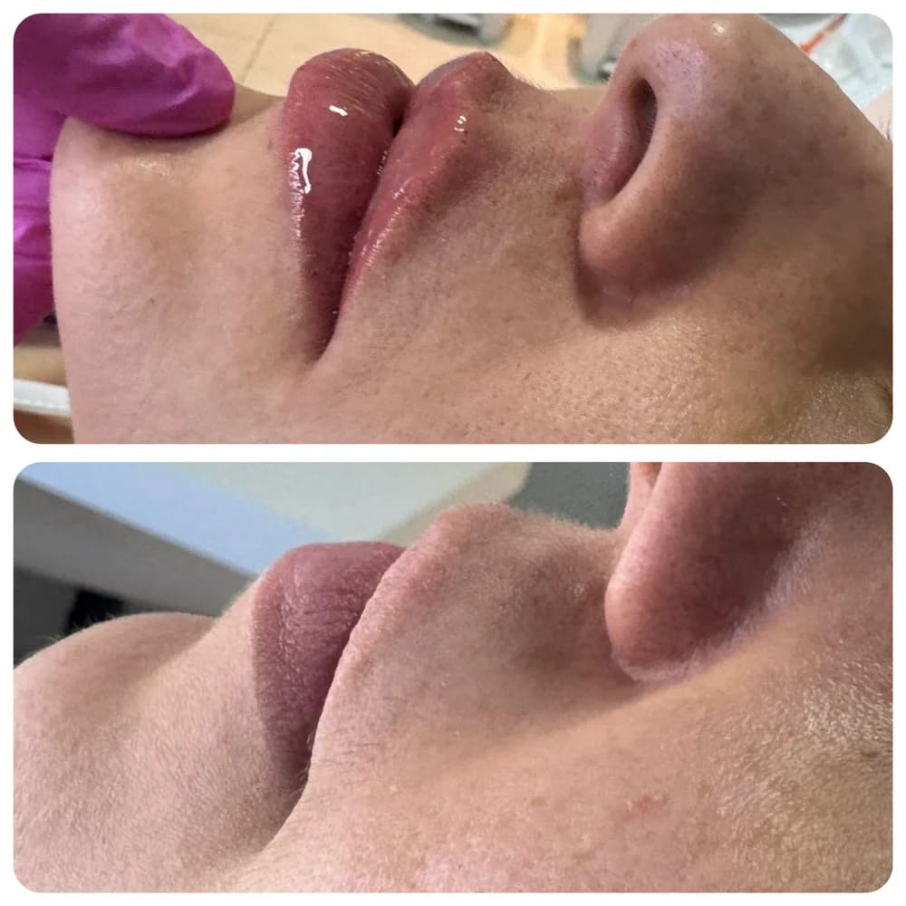 Preenchimento labial — comparativo 1