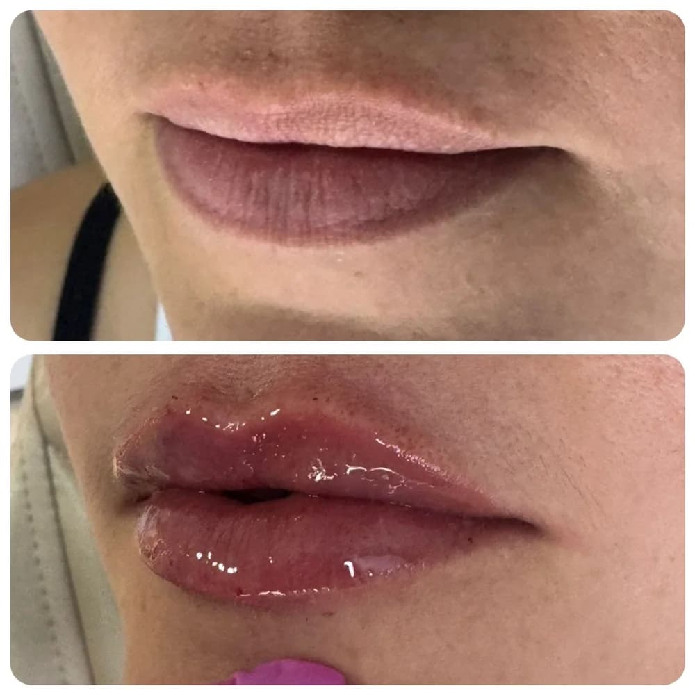 Preenchimento labial — comparativo 2