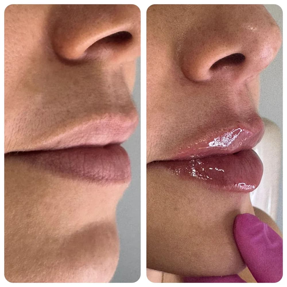 Preenchimento labial — comparativo 3
