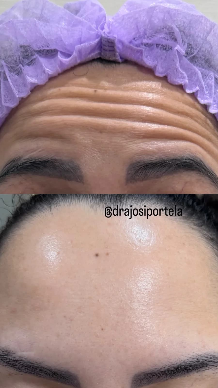 Toxina botulínica — comparativo 1