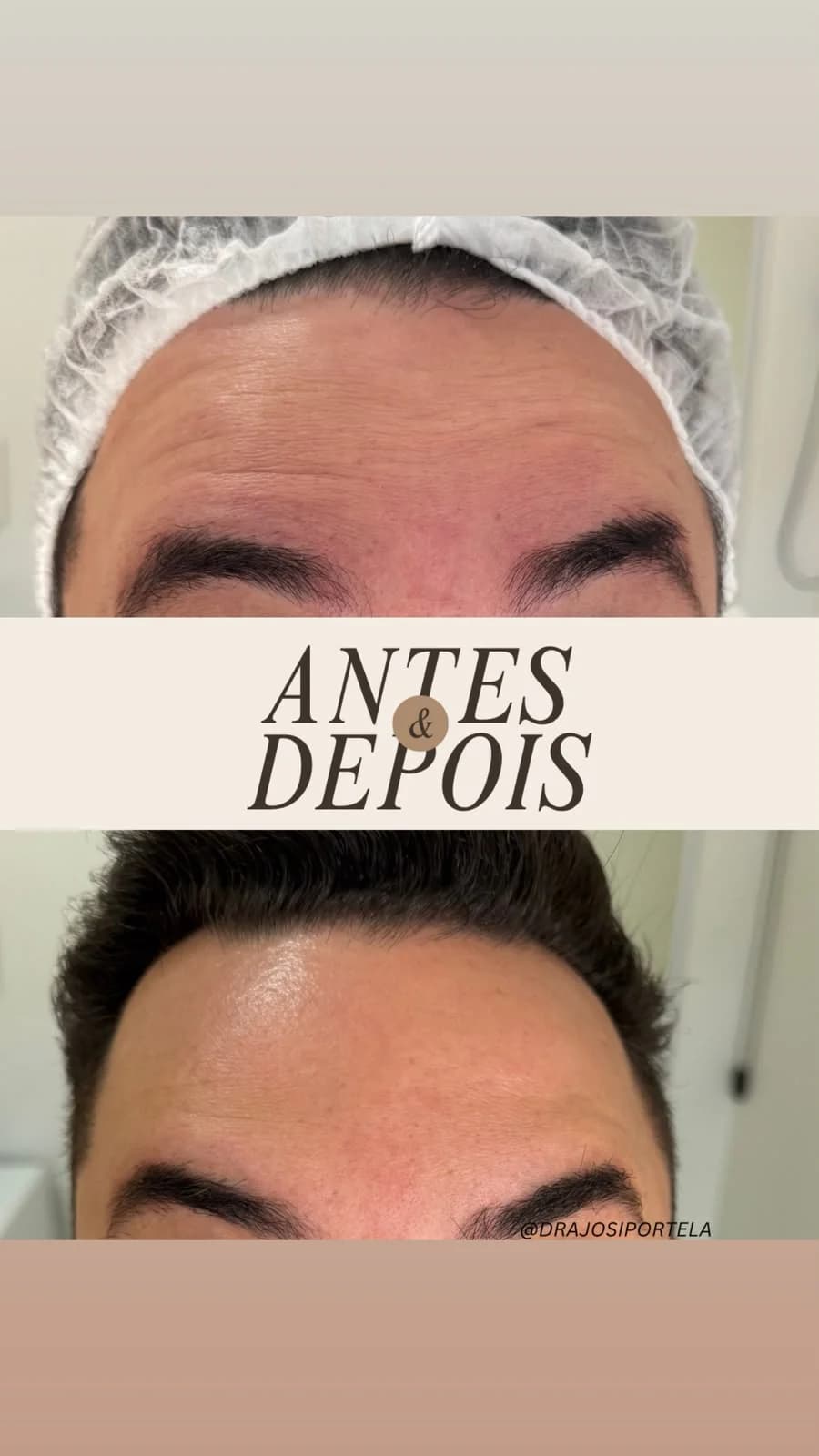 Toxina botulínica — comparativo 2